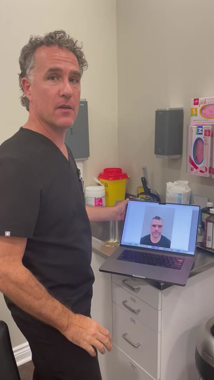 Case Study 14 - 10 months after FUE Hair Transplant