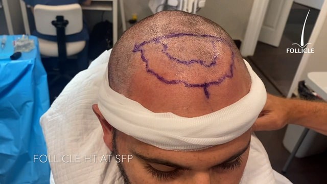 Case Study - FUE Technique