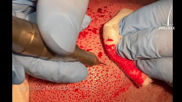 FUE Hair Transplant Surgery on Men Patient 2