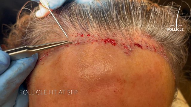 FUT Hair Transplant Surgery
