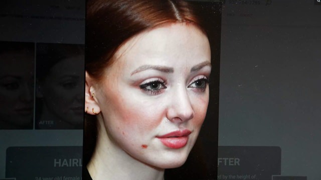 Hairline Lowering Before & After