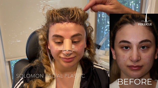 Case Study 12 - HAIRLINE LOWERING SURGERY PATIENT 2 POST UP