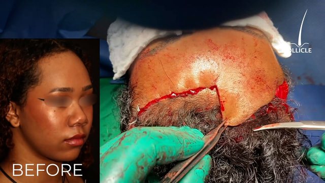 Hairline Lowering Surgery Patient 4