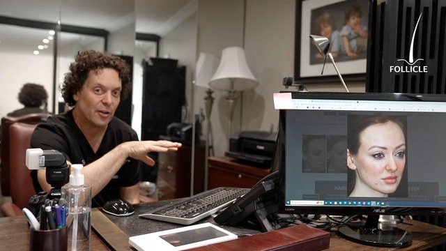  CASE STUDY 5 - HAIRLINE LOWERING