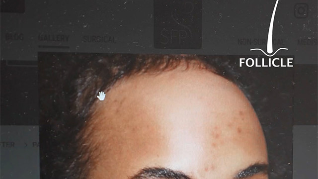 Case Study 8 - HAIRLINE LOWERING