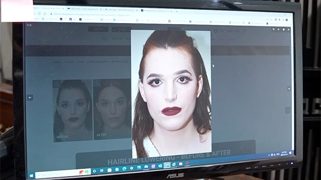 Case Study 7 - Hairline Lowering In Transgender Patient - Facial Feminisation