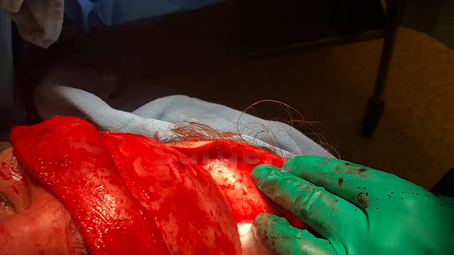  Hairline Lowering On 22 Year Old Transgender Patient