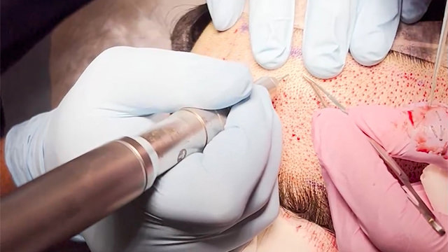 Follicle unit extraction