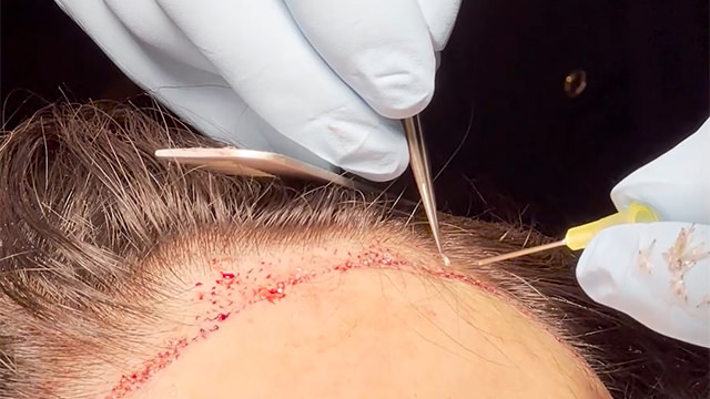 Implanting hair follicle