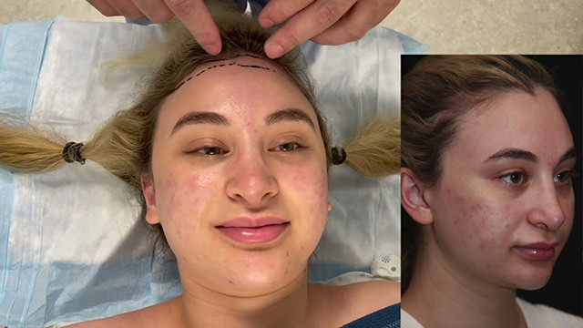 Hairline Lowering Surgery  Patient 2