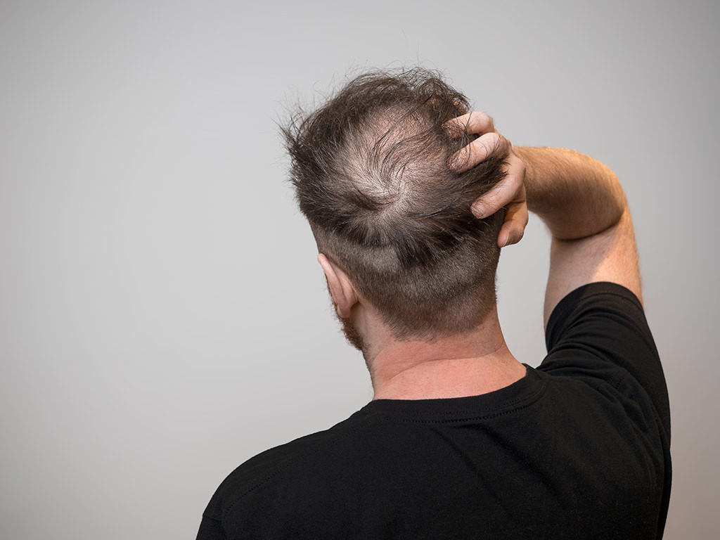 FUE hair restoration technique