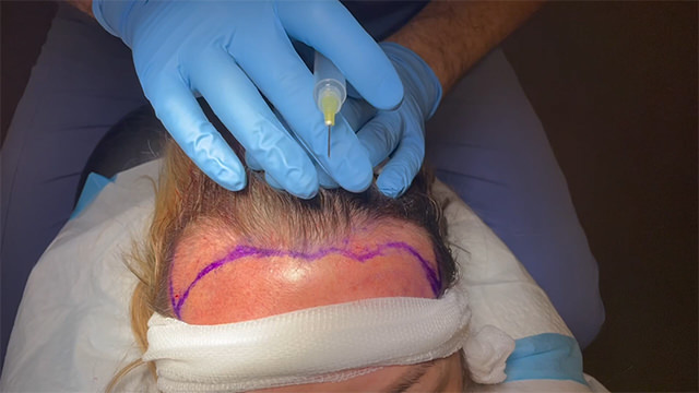 FUT Hair Transplant Surgery