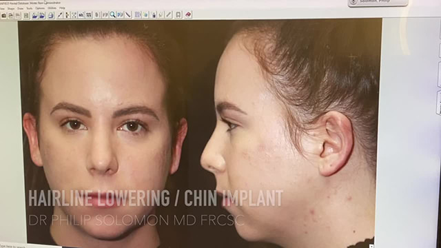 Case Study 10 - 1 Week Post Op Hairline Lowering Procedure