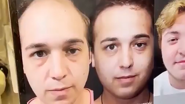 Transgender FTM beard restoration