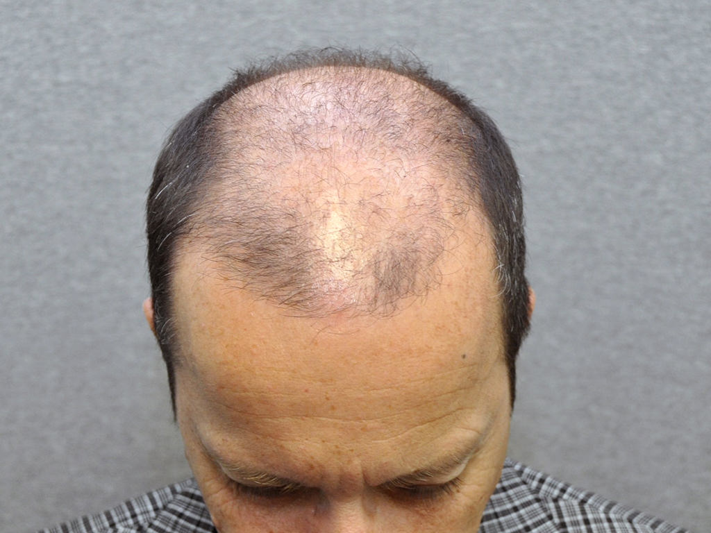 What causes hair loss?