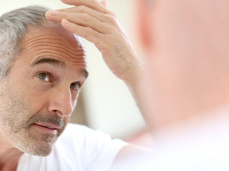 Hair Loss in Men