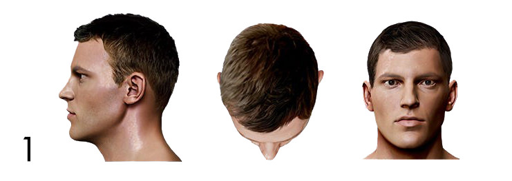 hair loss pattern