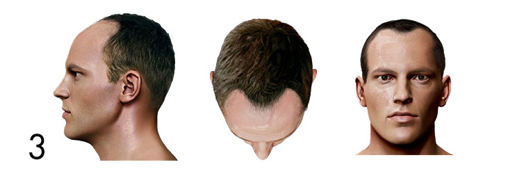 hair loss pattern