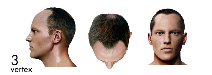 hair loss pattern