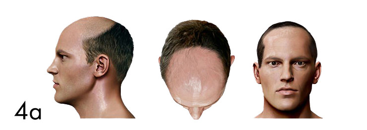 hair loss pattern