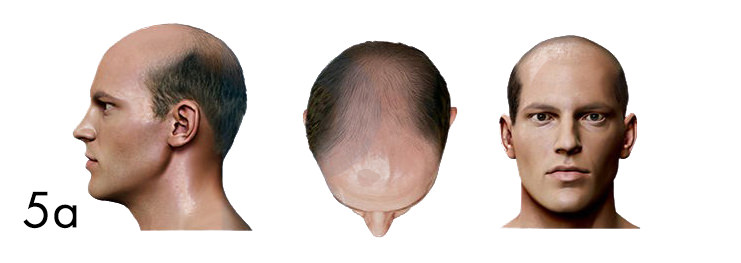 hair loss pattern