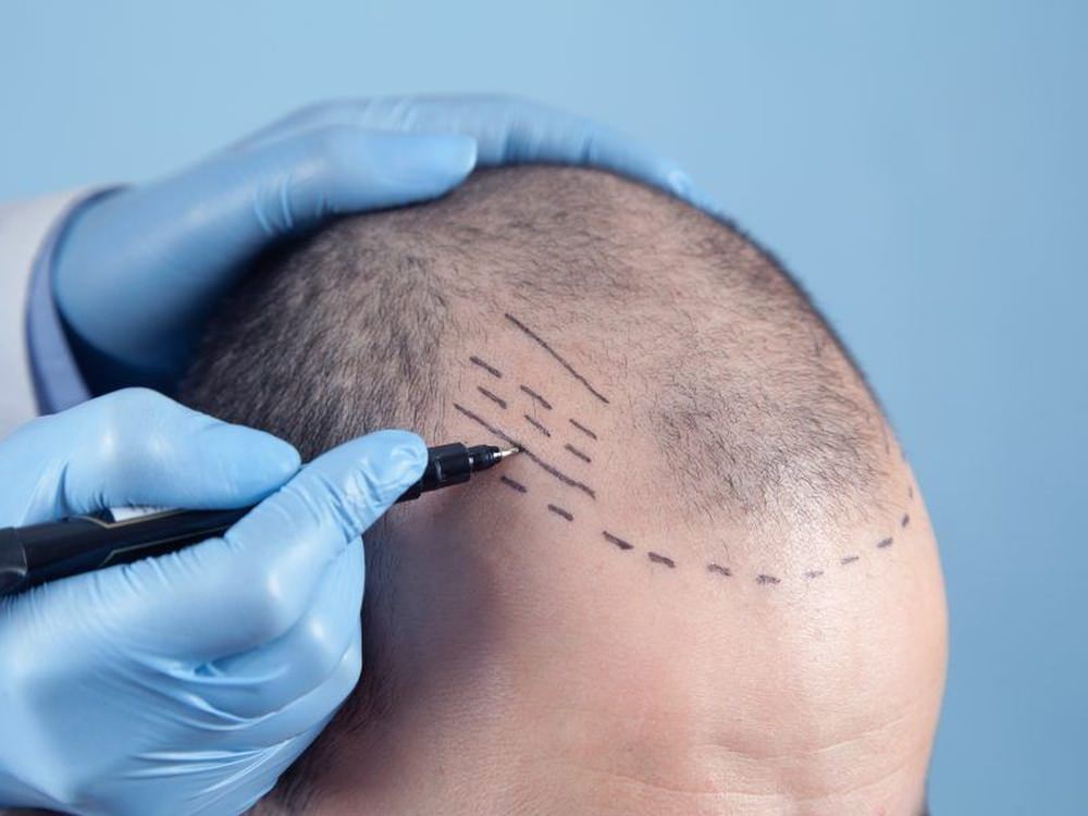 Hair Transplant Toronto