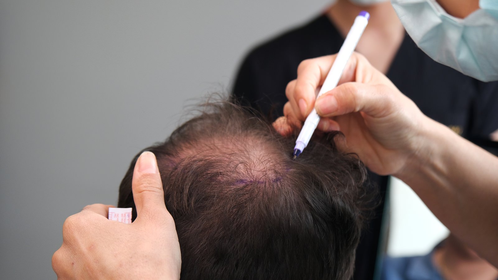 A Comprehensive Guide to FUE Hair Transplant in Toronto