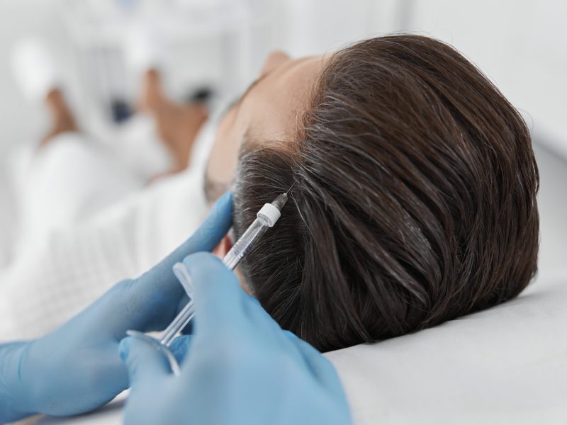 Unlocking the Potential of PRP Hair Treatment at FOLLICLE HT, Toronto