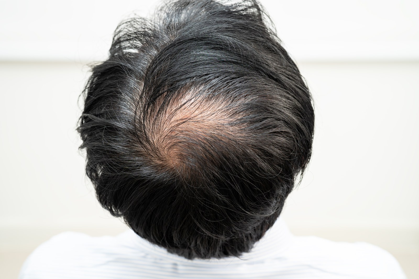 Who Is a Candidate for a Hair Transplant?