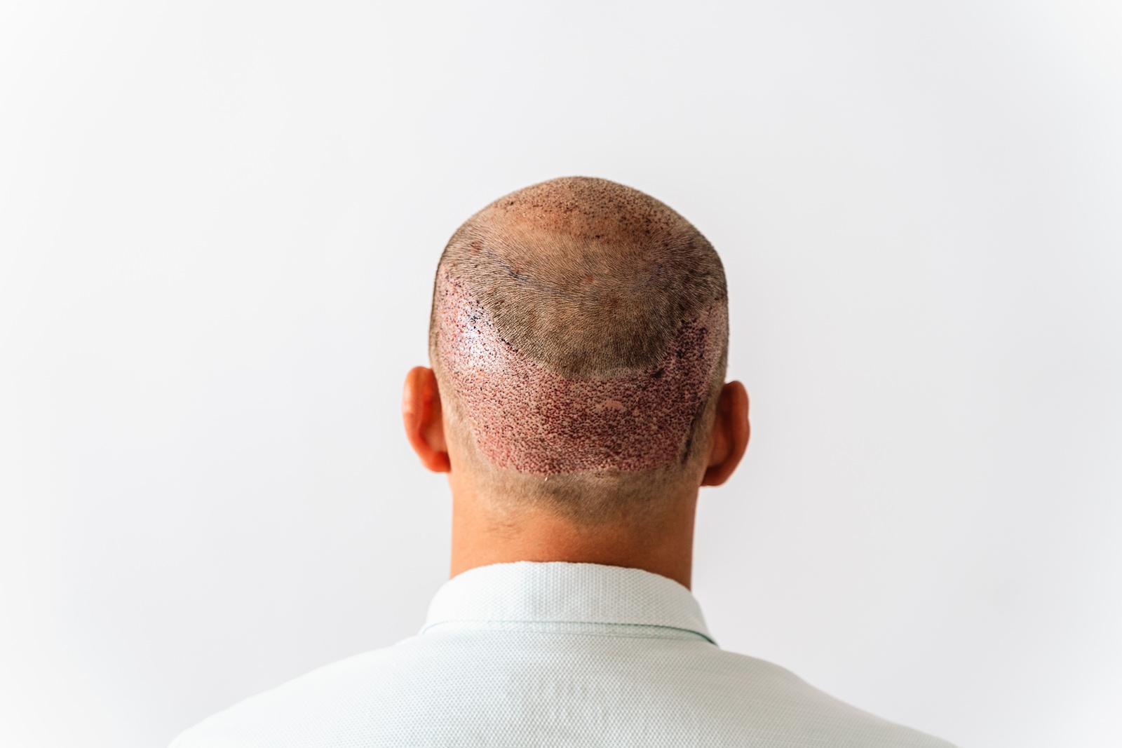 Breaking the Taboo and Stigma of Hair Transplants