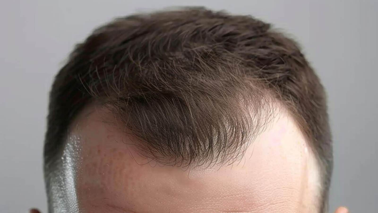 M-Shaped Hairline