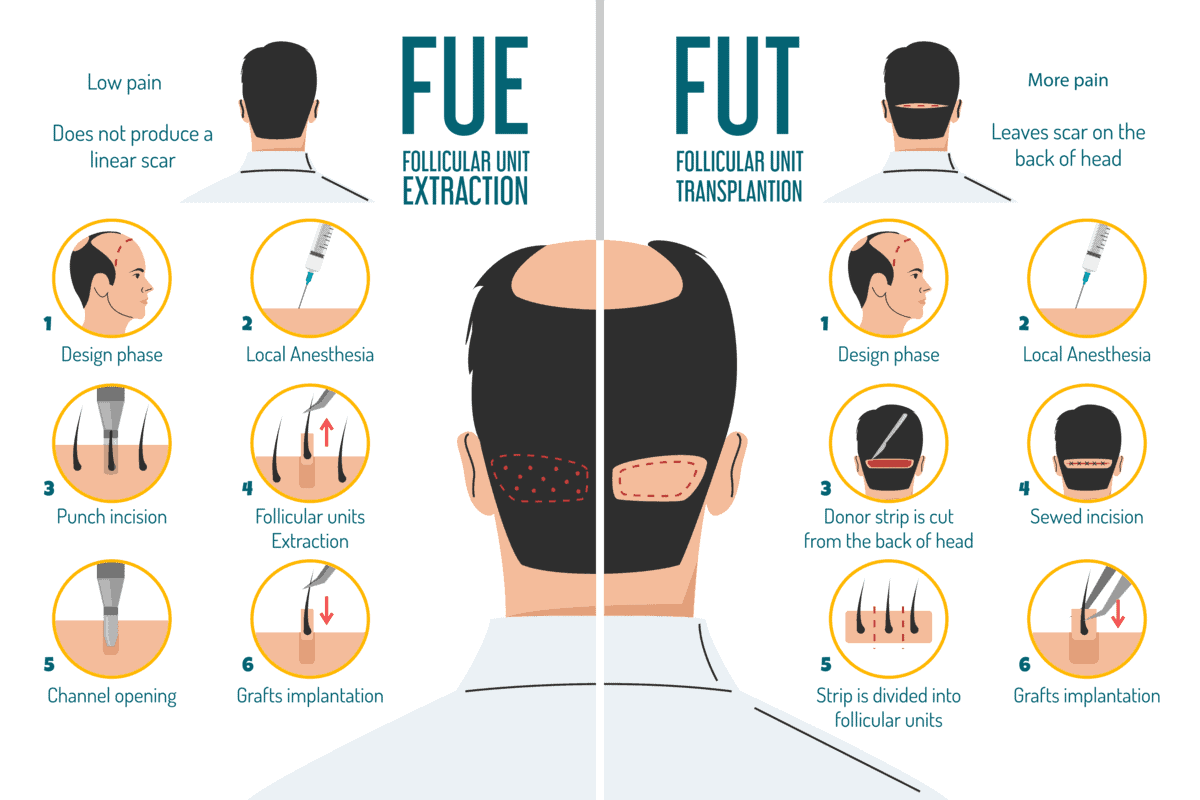 FUE vs. FUT: Which Hair Transplant Technique is Right for You?