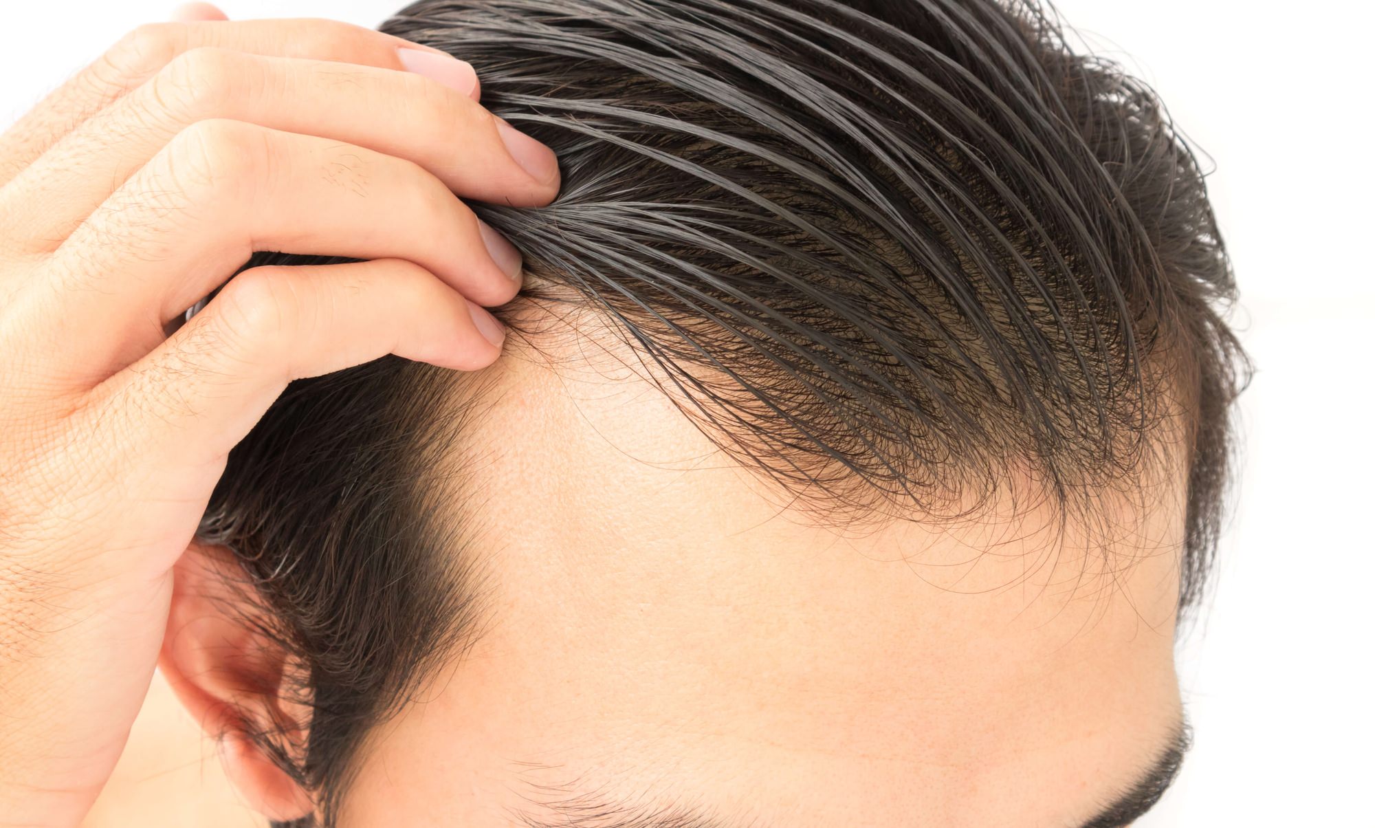 FUT vs. FUE: Choosing the Best Hair Restoration Technique