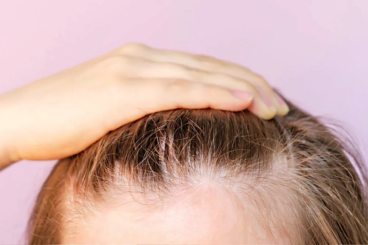 Transgender Feminization: Hair Restoration for a More Feminine Look