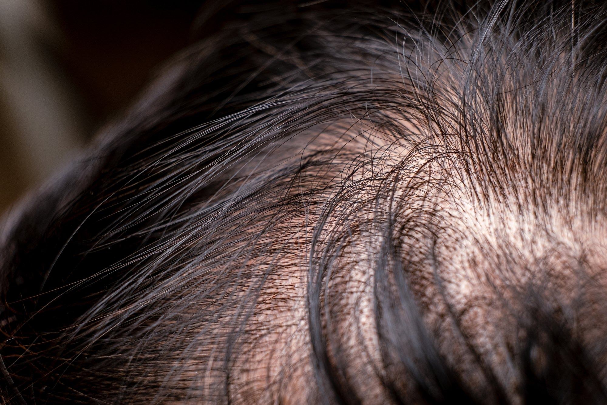The Benefits of FUE Hair Transplant
