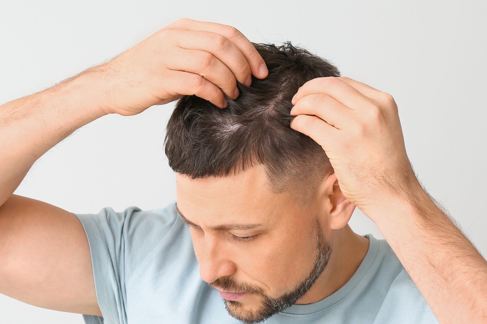 What is FUT Hair Transplant?